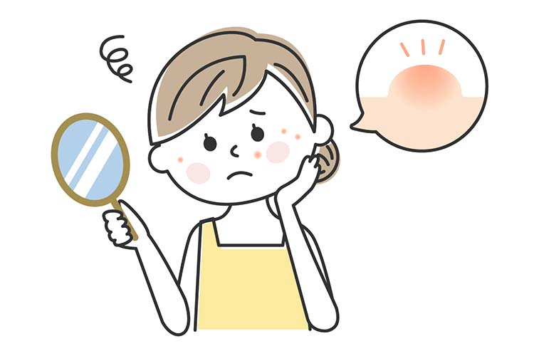 にきび・酒さのイメージ写真