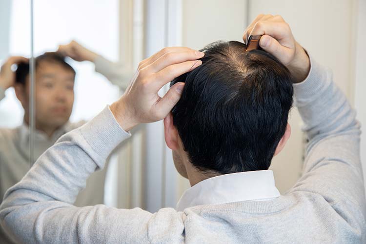 抜け毛・薄毛治療（AGA治療）のイメージ写真