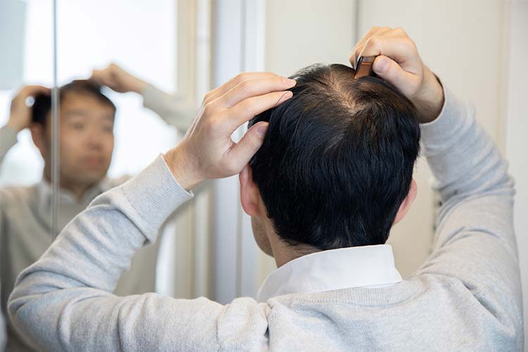 円形脱毛症のイメージ写真