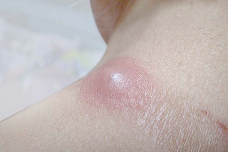 できもの・しこりのイメージ写真